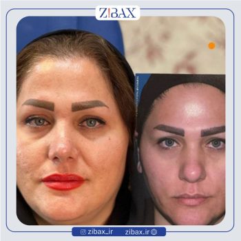 عمل بینی با دکتر بهرام بادامچی