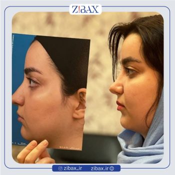 نمونه کار جراحی بینی با دکتر بهرام بادامچی