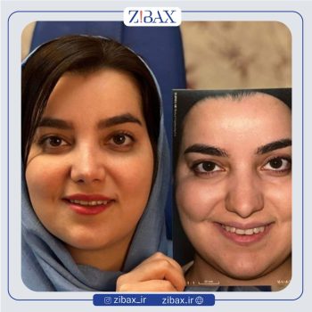 عمل راینوپلاستی بینی با دکتر بهرام بادامچی