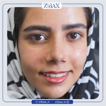 جراحی بینی گوشی با دکتر نسرین یزدانی