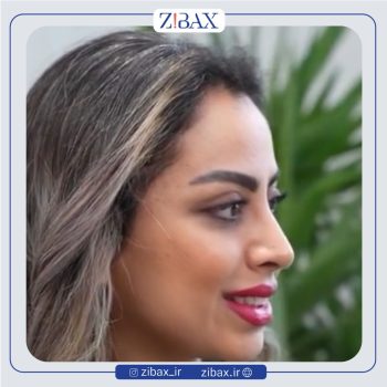 عمل طبیعی بینی با دکتر نسرین یزدانی