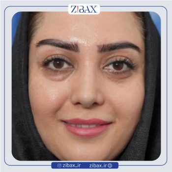 جراحی بینی زنانه با دکتر نسرین یزدانی
