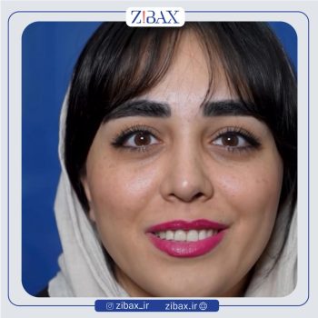 نمونه کار عمل زیبایی بینی با دکتر نسرین یزدانی