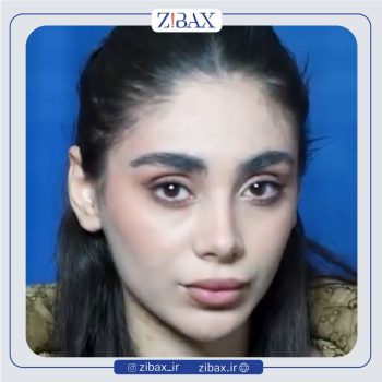 جراحی بینی طبیعی با دکتر نسرین یزدانی