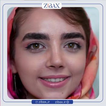 جراحی بینی با دکتر نسرین یزدانی