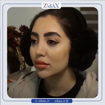 نمونه عمل بینی با دکتر بابک خسرویان