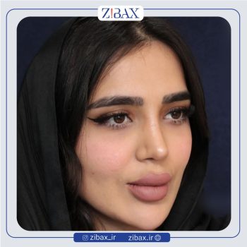 نمونه جراحی بینی با دکتر حسام جهاندیده در تهران