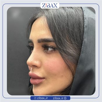 عکس نمونه کار جراحی بینی با دکتر حسام جهاندیده در تهران