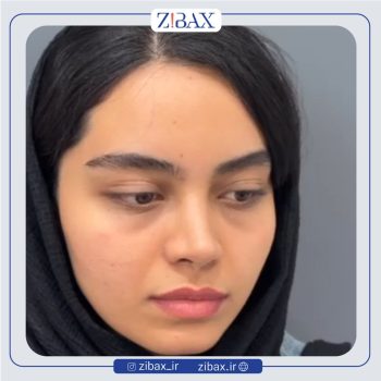 نمونه کار عمل زیبایی بینی دکتر حسام جهاندیده در تهران