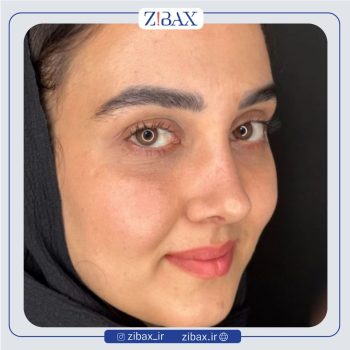 جراحی بینی با دکتر حسام جهاندیده در تهران