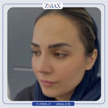 نمونه عمل زیبایی بینی دکتر حسام جهاندیده تهران