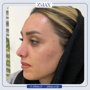 نمونه عمل بینی با دکتر مهرداد جعفری