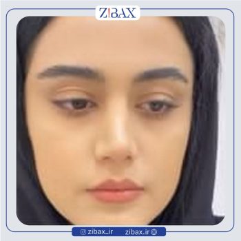 جراحی زیبایی بینی با دکتر مهرداد جعفری