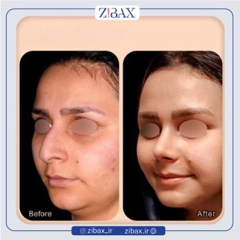 نمونه کار جراحی بینی با دکتر وحیده درتاج جراح بینی تهران