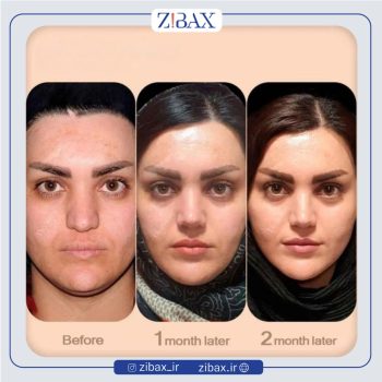 نمونه جراحی دماغ با دکتر وحیده درتاج جراح بینی تهران