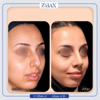 نمونه کار عمل دماغ با دکتر وحیده درتاج جراح بینی تهران