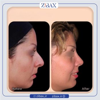 نمونه کار عمل بینی با دکتر وحیده درتاج جراح بینی تهران