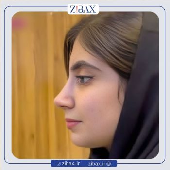 نمونه عمل بینی طبیعی با دکتر مجتبی قائدی