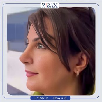 نمونه کار راینوپلاستی بینی با دکتر مجتبی قائدی