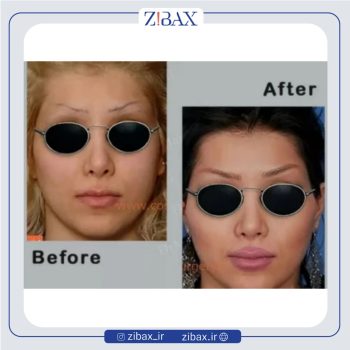 عکس نمونه کار جراحی بینی با دکتر علی منافی در تهران