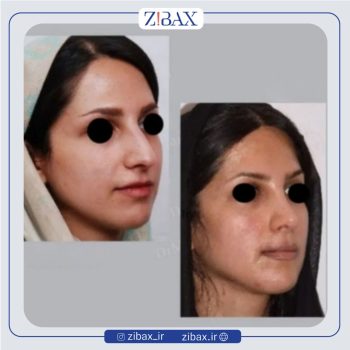 نمونه کار جراحی بینی با دکتر علی منافی جراح بینی تهران