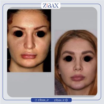 نمونه جراحی زیبایی بینی با دکتر علی منافی جراح بینی تهران