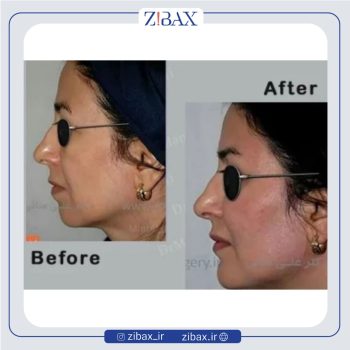 نمونه کار عمل زیبایی بینی دکتر علی منافی در تهران