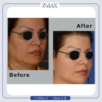 جراحی بینی با دکتر علی منافی در تهران