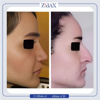 جراحی طبیعی بینی زنانه با دکتر اردلان دهقانی