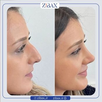 عمل زیبایی بینی با دکتر اردلان دهقانی