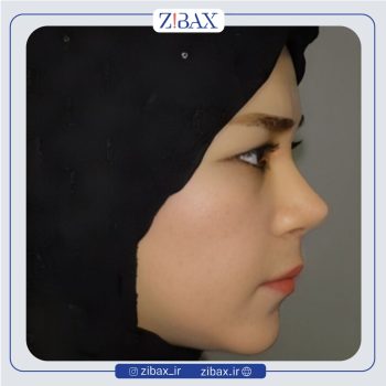 نمونه جراحی بینی با دکتر هرمز بازیاری دلاور جراح بینی تهران
