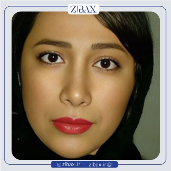 نمونه عمل دماغ با دکتر هرمز بازیاری دلاور جراح بینی تهران