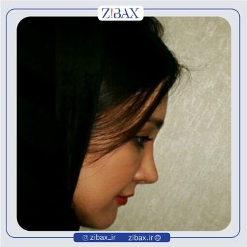 نمونه کار عمل بینی با دکتر هرمز بازیاری دلاور جراح بینی تهران