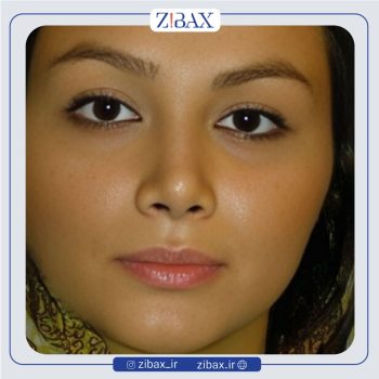 نمونه عمل بینی با دکتر هرمز بازیاری دلاور جراح بینی تهران