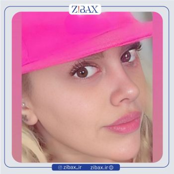 نمونه کار عمل دماغ با دکتر پوپک ایزدی جراح بینی تهران