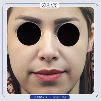 نمونه جراحی بینی با دکتر پوپک ایزدی جراح بینی تهران