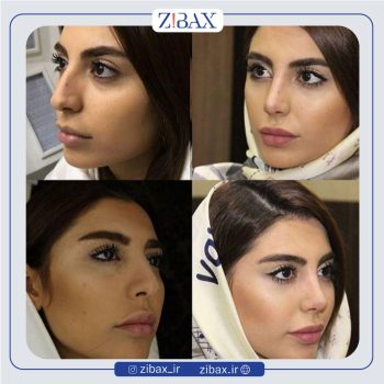 نمونه عمل بینی با دکتر ارسطو اشتری جراح بینی تهران