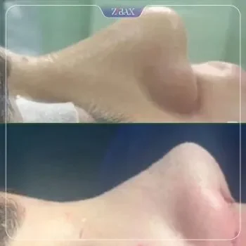 نمونه عمل بینی طبیعی دکتر سعدالله صمدی کرمان