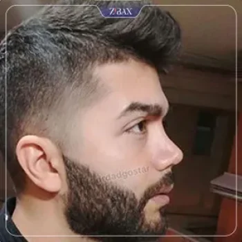 نمونه کار عمل بینی دکتر علیرضا دادگستر