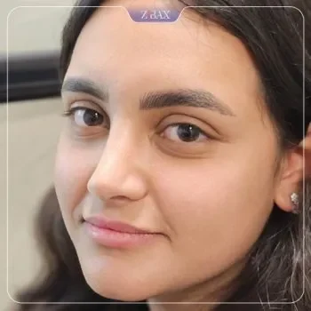 نمونه کار جراحی بینی دکتر برخورداری شیراز