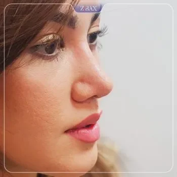 نمونه کار دکتر خسرو برخورداری جراحی بینی شیراز