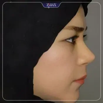نمونه کار عمل بینی دکتر هرمز بازیاری دلاور