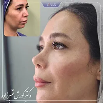 نمونه جراحی بینی بینی دکتر کورش قنبر زاده