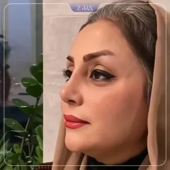 نمونه جراحی بینی دکتر رویا جاویدی جراح بینی شیراز