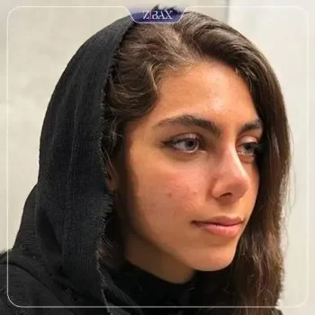 نمونه جراحی بینی طبیعی دکتر جاویدی شیراز