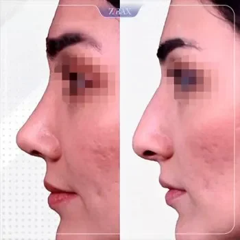 نمونه کار عمل بینی دکتر عین آبادی شیراز