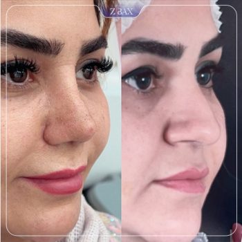 نمونه جراحی بینی توسط دکتر سپیده آتشی جراح بینی شیراز