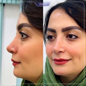 نمونه جراحی بینی توسط دکتر سپیده آتشی جراح بینی شیراز