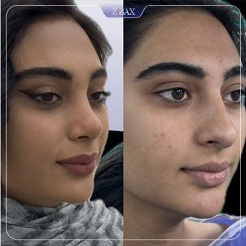 نمونه جراحی بینی توسط دکتر سپیده آتشی جراح بینی شیراز