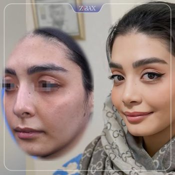 جراحی بینی توسط دکتر آرش شرفیان در تهران